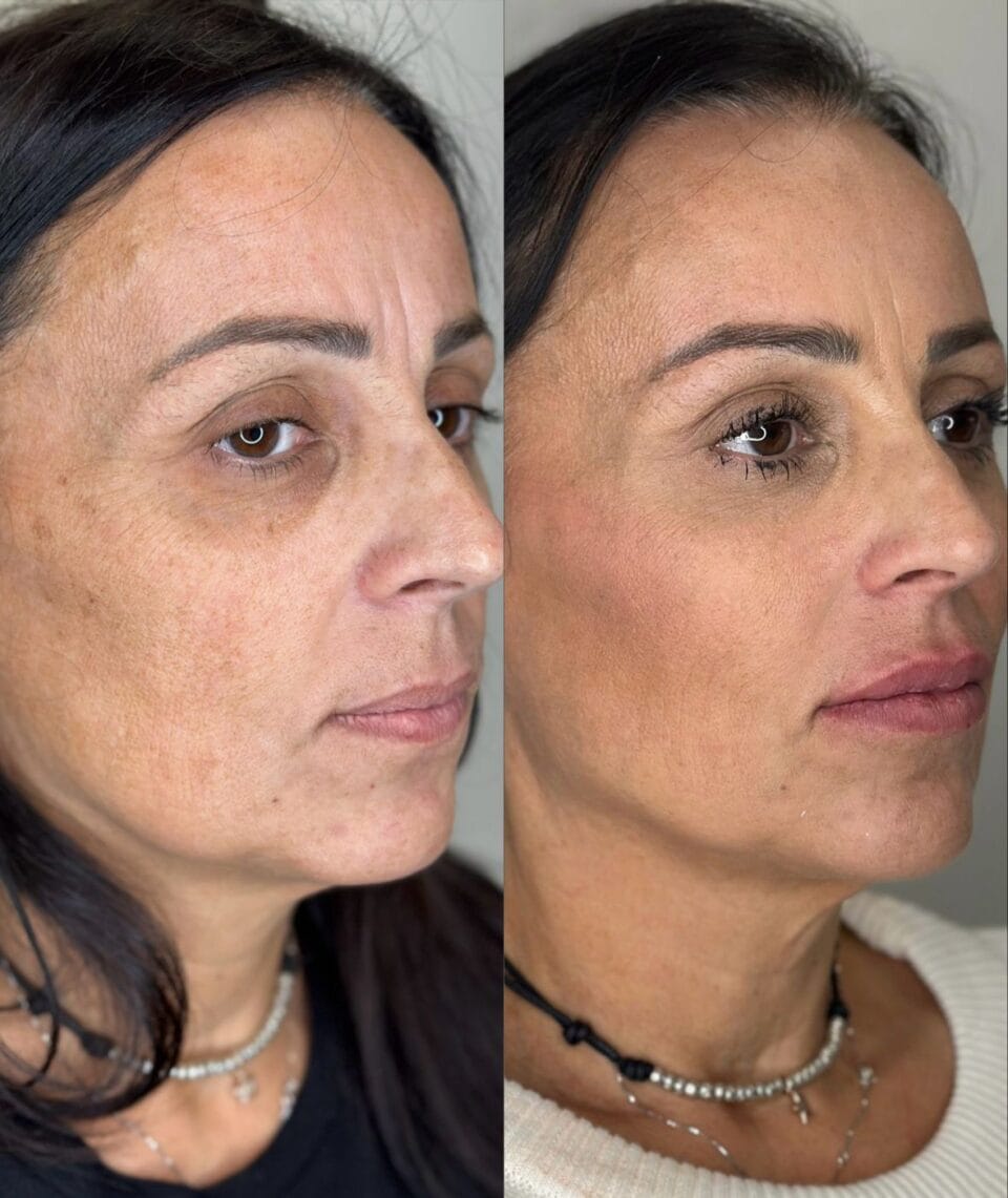 Prima e dopo trattamento estetico viso